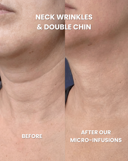 Anti-Aging Micro Infusion