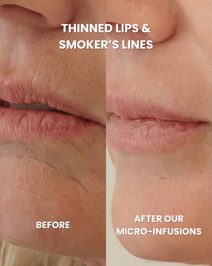 Anti-Aging Micro Infusion